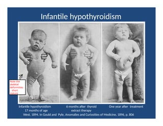 Infantile hypothyroidism
Infantile hypothyroidism 6 months after thyroid One year after treatment
17 months of age extract therapy
West. 1894. In Gould and Pyle, Anomalies and Curiosities of Medicine, 1896, p. 806
Note the
skeletal
deformities
, short
stature
 