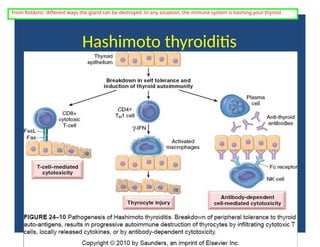 Hashimoto thyroiditis
From Robbins: different ways the gland can be destroyed. In any situation, the immune system is bashing your thyroid
 