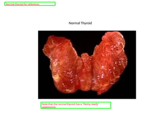 Normal Thyroid
Note that the normal thyroid has a "fleshy, beefy"
appearance.
Normal thyroid for reference.
 