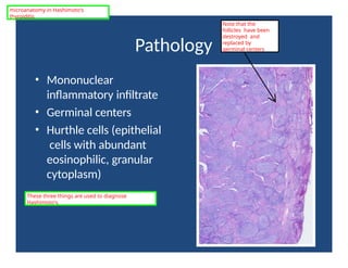 Pathology
• Mononuclear
inflammatory infiltrate
• Germinal centers
• Hurthle cells (epithelial
cells with abundant
eosinophilic, granular
cytoplasm)
microanatomy in Hashimoto's
thyroiditis
Note that the
follicles have been
destroyed and
replaced by
germinal centers
These three things are used to diagnose
Hashimoto's.
 