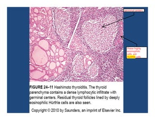 These highly
eosinophilic
cells are
Hurthle cells
germinal centers
 