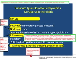 Subacute (granulomatous) thyroiditis
De Quervain thyroiditis
• F:M 3:1
• Post viral
‐ inflammatory process (seasonal)
• Neck pain, fever
• Transient hyperthyroidism > transient hypothyroidism >
full recovery
• Pathology:
Follicles destroyed by neutrophilic microabscesses
• Multinucleate giant cells enclosing pools of colloid
different
from
Hashimoto's
,
which
is
painles
s
A viral infection leads to an autoimmunity that attacks the thyroid gland. There is initial
hyperthyroidism as the follicular cells are damaged, allowing colloid and thyroid hormones
to enter the blood. Then, the pituitary downregulates TSH production through feedback, and
the released colloid is depleted, leading to transient hypothyroidism. There is an eventual
full recovery.
What three microscopic
observations are used
to diagnose
Hashimoto's
thyroiditis?
This
differs
fro
m
Hashimoto'
s
which has no •
full
recovery
since
the
gland
is
destroyed
and
fibrosed
.
De Quervain thyroiditis: a rare thyroiditis that elicits neck pain and goes through various stages leading to full recovery
tcl12
--------------------------------------------
mononuclear inflammatory cell infiltrates (mostly lymphocytes), germinal centers
and Hurthle cells
 
