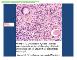 Giant cell
engulfing
the colloid
microanatomy of granulomatous (De Guervain's) thyroiditis
 