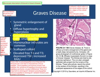 Graves Disease
• Symmetric enlargement of
gland
• Diffuse hypertrophy and
hyperplasia
• Crowded and tall follicular
cells; small papillae
• Mononuclear infiltrates are
common
• Scalloped colloid
• Elevated free T4 and T3;
depressed TSH; increased
RAIU
Normal follicles
would be nice
and round.
These refer to pseudopapillae since they lack the
fibrovascular core that is characteristic of true
papillae. Since papillary carcinomas contain real
papillae, the presence of papillary structures place
papillary carcinoma on your differential. Thus, it is
important to distinguish between pseudopapillae
and true papillae to distinguish between Grave's and
papillary carcinoma.
Scalloped colloid refers to
the round, white cicles on
the edges of the colloid
space.
This indicates active
uptake of stored colloid.
scallope
d
colloid
=
anothe
r
buzzword
to
remembe
r
(see box
in
upper
right
hand
corner
for
an
explanatio
n)
Microscopic description of thyroid in Grave's Disease
 