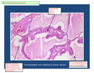 Pseudopapillae and scalloping in Graves’ disease
Note this pseudopapillae.
It lacks the fibrovascular
core of a true papillae.
Note the scalloped
colloid (edges of the
colloid look like they
have round bites taken
out of them)
Note how tall
those
follicular
cells are.
More histology of Grave's Disease
 