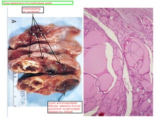 multinodularity
on cut section
round and encapsulated
follicular adenoma. It is not
uncommon to see multiple
diseases in a thyroid.
Gross appearance of a multinodular goiter.
 