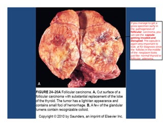 If you manage to get a
gross specimen early in
the pathogenesis of
follicular carcinoma, you
can see the capsule
getting invaded and
disrupted. The capsule is
again very important to
look at for diagnosis since
the follicles in the middle
of the neoplasm looks
just like normal thyroid or
follicular adenoma.
 