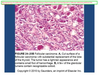 Microanatomy of a follicular carcinoma. It is bland looking in that it looks like a normal thyroid or follicular adenoma without the
capsule in view.
 