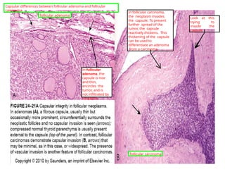 In follicular
adenoma, the
capsule is nice
and thin,
encircles the
tumor, and is
not infiltrated by
neoplasm.
In follicular carcinoma,
the neoplasm invades
the capsule. To prevent
further spread of the
tumor, the capsule
reactively thickens. This
thickening of the capsule
can be used to
differentiate an adenoma
from a carcinoma.
Look at this
trying to
invade the
capsule
follicular adenoma
follicular carcinoma
Capsular differences between follicular adenoma and follicular
carcinoma.
 