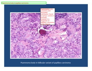 Psammoma body in follicular variant of papillary carcinoma
Psammoma body:
concentric and
laminated
calcification found
in various tumors in
the body.
However, it is
diagnostic of
papillary carcinoma
in the thyroid.
Psammoma body in papillary carcinoma
 