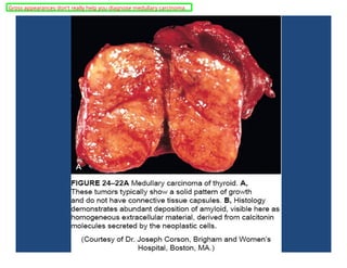 Gross appearances don't really help you diagnose medullary carcinoma.
 