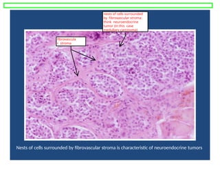Nests of cells surrounded by fibrovascular stroma is characteristic of neuroendocrine tumors
nests of cells surrounded
by fibrovascular stroma:
think neuroendocrine
tumor (in this case
medullary carcinoma)
fibrovascula
r stroma
 