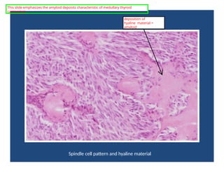 Spindle cell pattern and hyaline material
deposition of
hyaline material =
amyloid
This slide emphasizes the amyloid deposits characteristic of medullary thyroid
carcinomas.
 