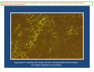 "Apple green" staining with Congo red stain and polarization demonstrates
the hyaline deposits to be amyloid
Apple-green color with Congo red stain and polarization = amyloid. Again, another slide emphasizing that medullary thyroid
carcinomas have amyloid deposits.
 