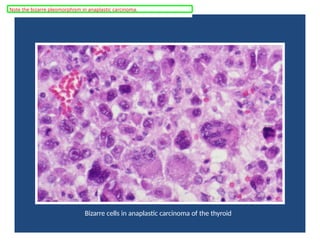 Bizarre cells in anaplastic carcinoma of the thyroid
Note the bizarre pleomorphism in anaplastic carcinoma.
 