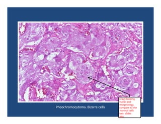 Pheochromocytoma. Bizarre cells
Crazy looking
nuclei and
morphology.
compare to the
normal cells
two slides
ago.
 