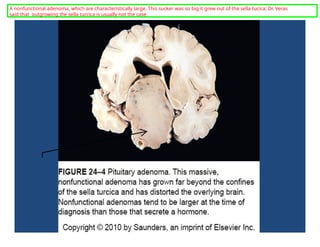A nonfunctional adenoma, which are characteristically large. This sucker was so big it grew out of the sella tucica; Dr. Veras
said that outgrowing the sella turcica is usually not the case.
 