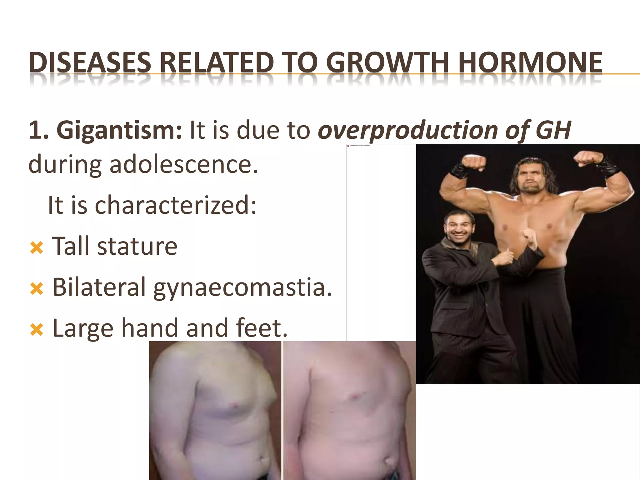 DISEASES RELATED TO GROWTH HORMONE
1. Gigantism: It is due to overproduction of GH
during adolescence.
It is characterized:
 Tall stature
 Bilateral gynaecomastia.
 Large hand and feet.
 