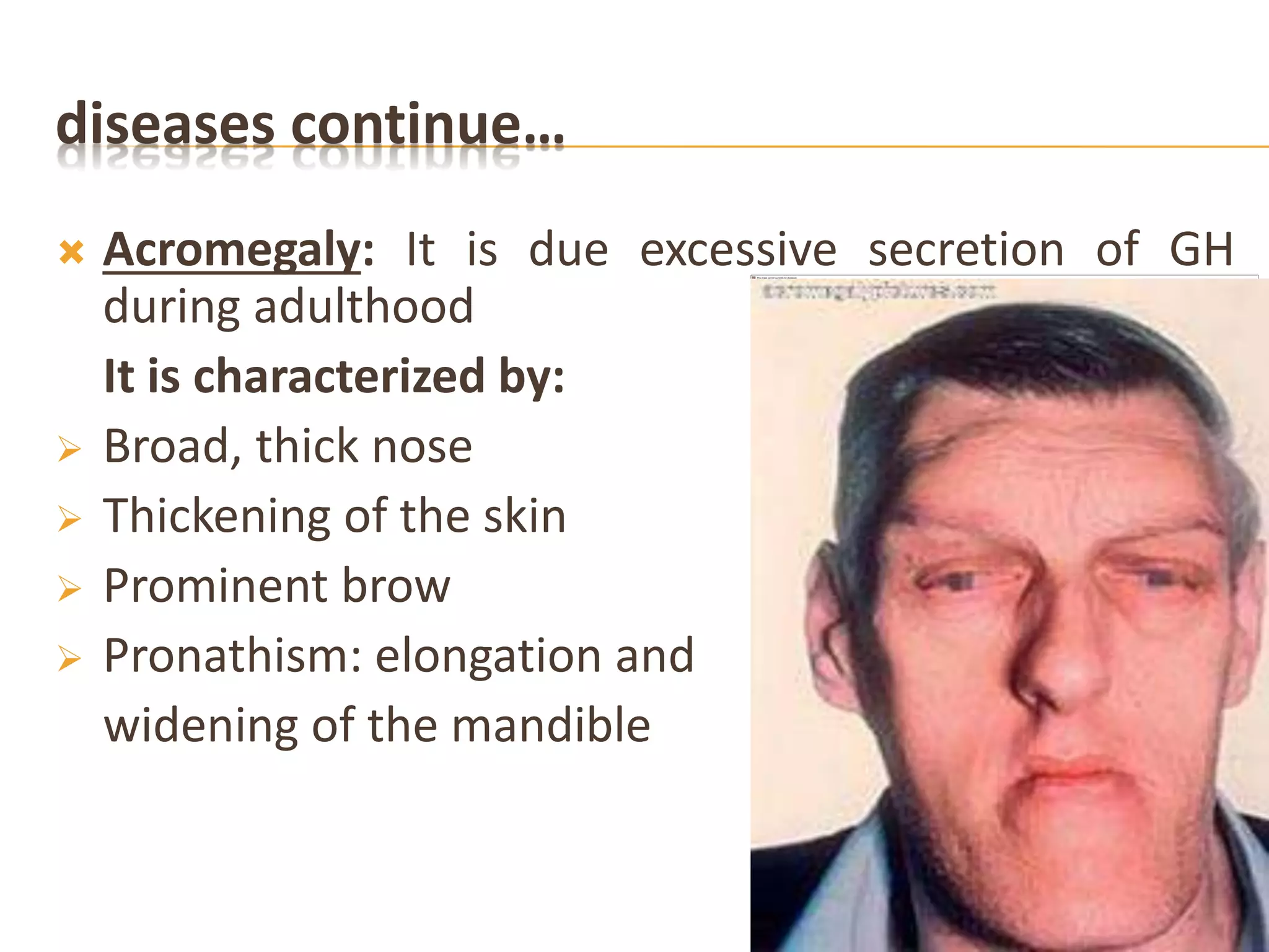 diseases continue…
 Acromegaly: It is due excessive secretion of GH
during adulthood
It is characterized by:
 Broad, thick nose
 Thickening of the skin
 Prominent brow
 Pronathism: elongation and
widening of the mandible
 