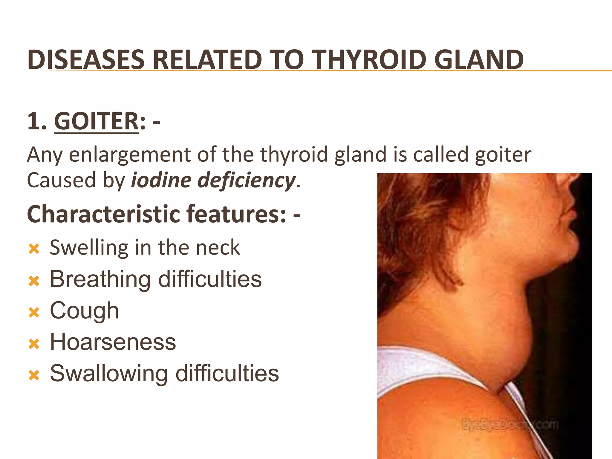 DISEASES RELATED TO THYROID GLAND
1. GOITER: -
Any enlargement of the thyroid gland is called goiter
Caused by iodine deficiency.
Characteristic features: -
 Swelling in the neck
 Breathing difficulties
 Cough
 Hoarseness
 Swallowing difficulties
 