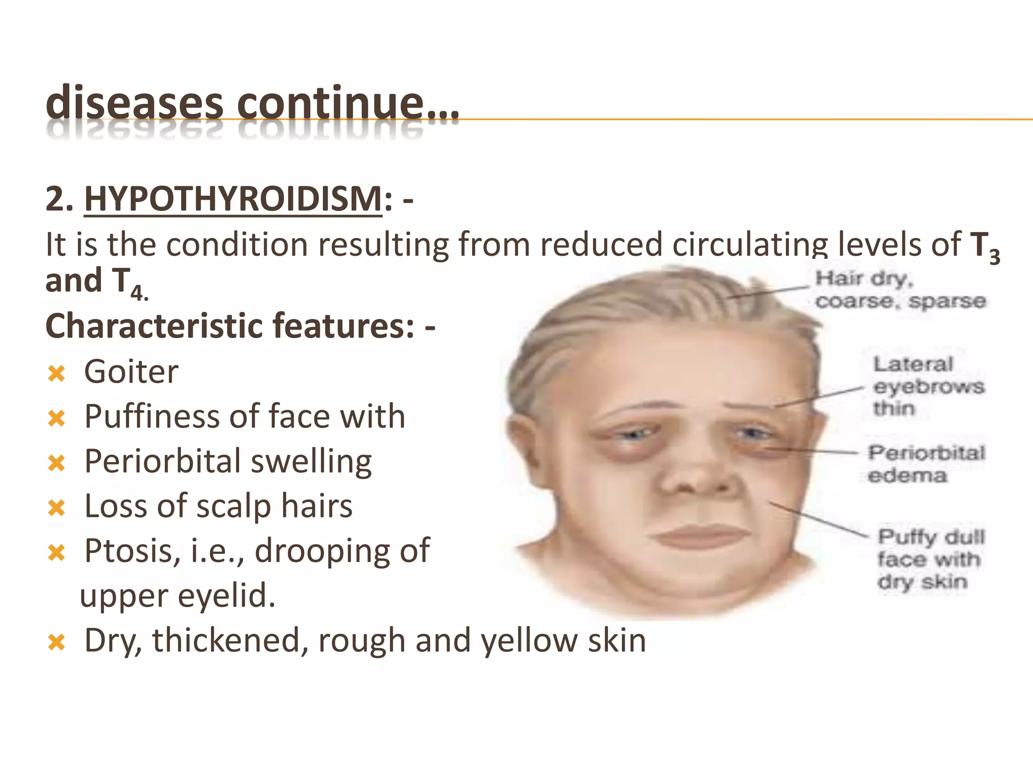 diseases continue…
2. HYPOTHYROIDISM: -
It is the condition resulting from reduced circulating levels of T3
and T4.
Characteristic features: -
 Goiter
 Puffiness of face with
 Periorbital swelling
 Loss of scalp hairs
 Ptosis, i.e., drooping of
upper eyelid.
 Dry, thickened, rough and yellow skin
 