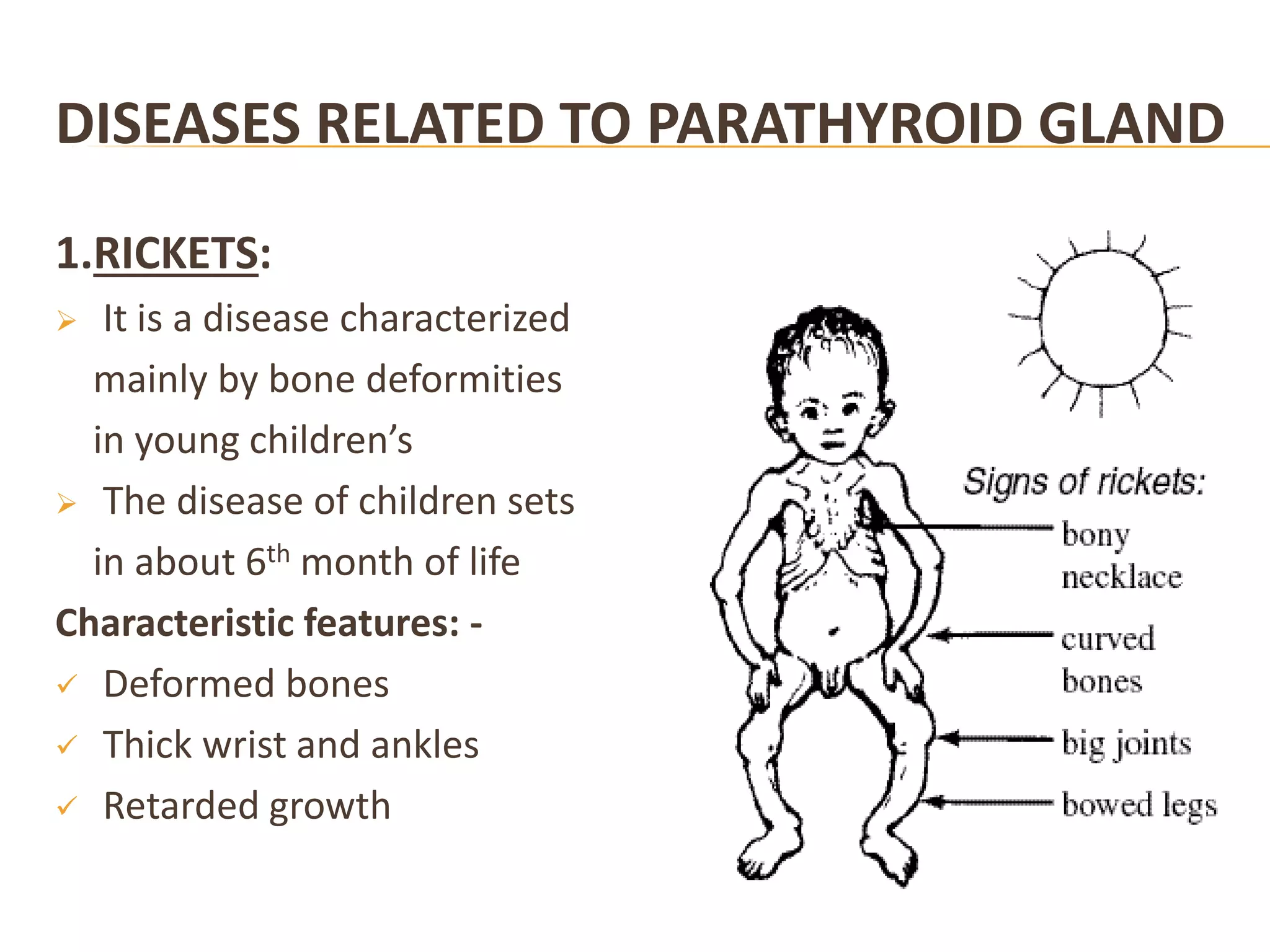 DISEASES RELATED TO PARATHYROID GLAND
1.RICKETS:
 It is a disease characterized
mainly by bone deformities
in young children’s
 The disease of children sets
in about 6th month of life
Characteristic features: -
 Deformed bones
 Thick wrist and ankles
 Retarded growth
 
