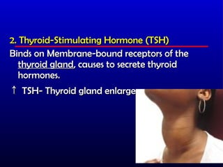 2. Thyroid-Stimulating Hormone (TSH)
Binds on Membrane-bound receptors of the
   thyroid gland, causes to secrete thyroid
   hormones.
↑ TSH- Thyroid gland enlarges
 
