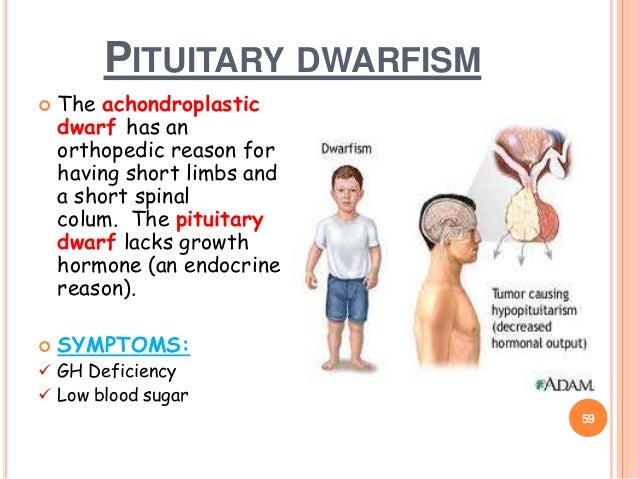 the pituitary gland and dwarfism essay Pituitary dwarfism occurs when the pituitary gland does not produce enough growth hormone this hormone plays a major role in growth of the skeleton and viscera if it is not produced in large enough quantities, growth of the trunk will be curtailed, and the head and limbs will be in normal proportion to the small torso. the pituitary gland and dwarfism essay Pituitary dwarfism occurs when the pituitary gland does not produce enough growth hormone this hormone plays a major role in growth of the skeleton and viscera if it is not produced in large enough quantities, growth of the trunk will be curtailed, and the head and limbs will be in normal proportion to the small torso.