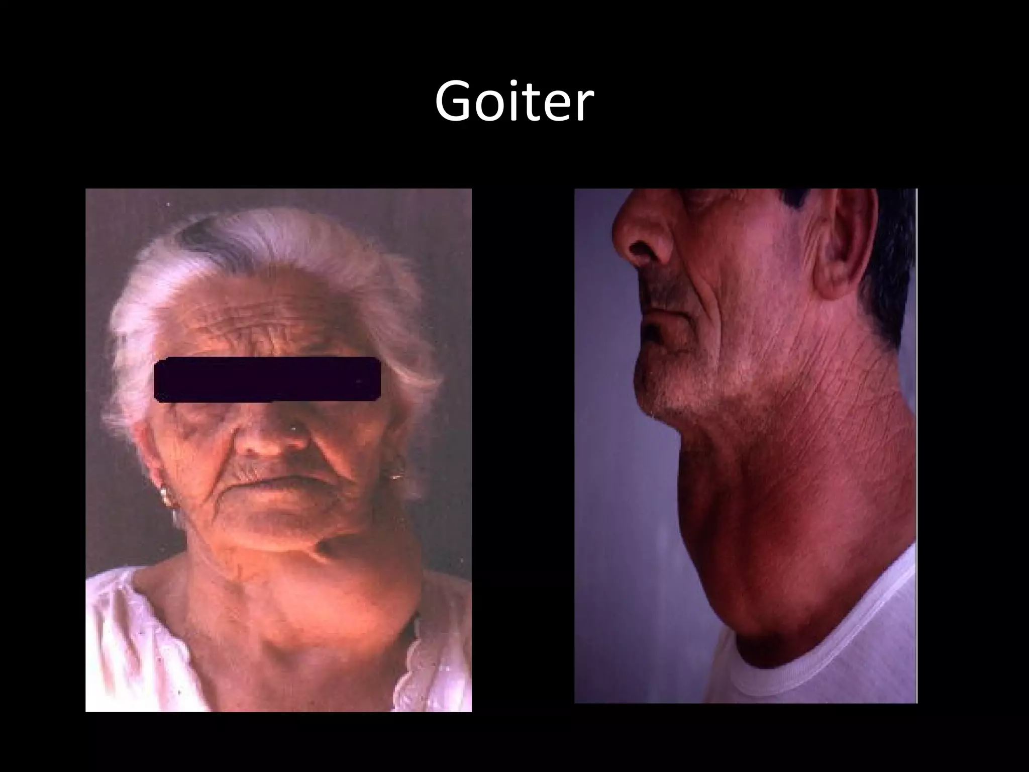 Goiter
 