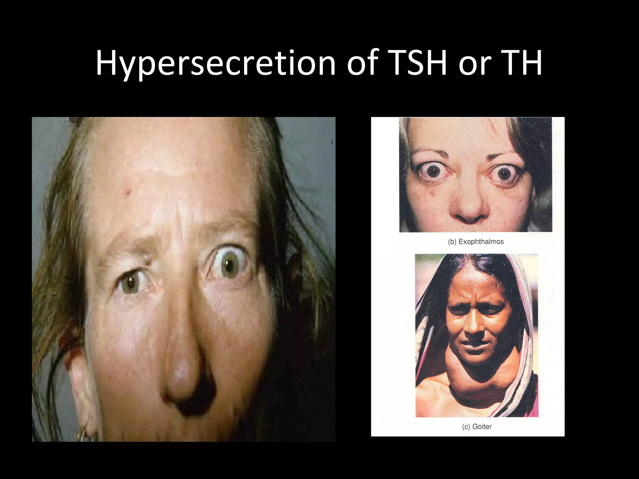 Hypersecretion of TSH or TH
 