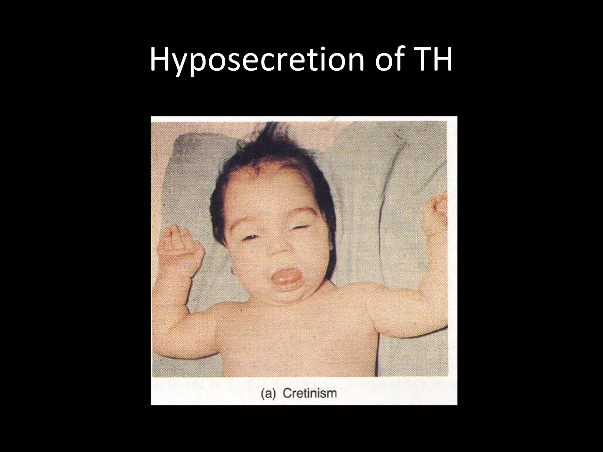 Hyposecretion of TH
 