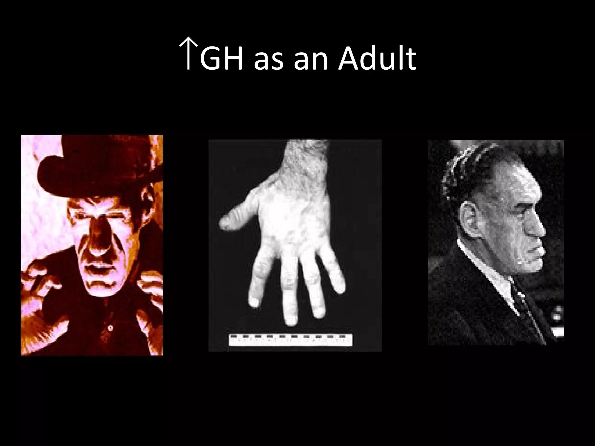 ↑GH as an Adult
 