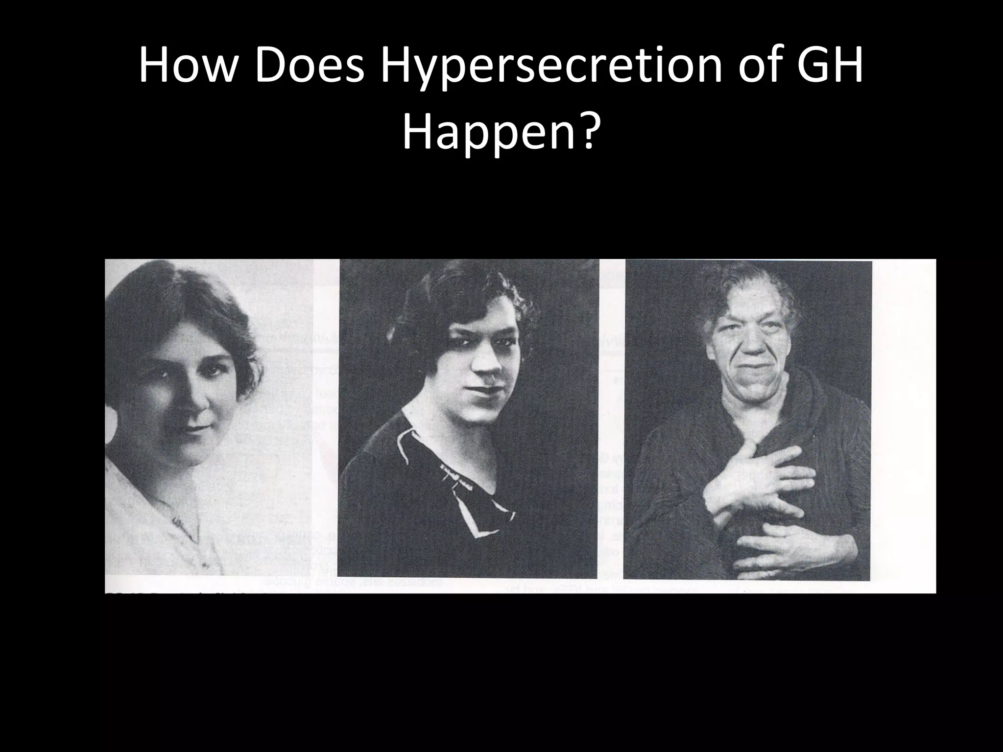 How Does Hypersecretion of GH
          Happen?
 