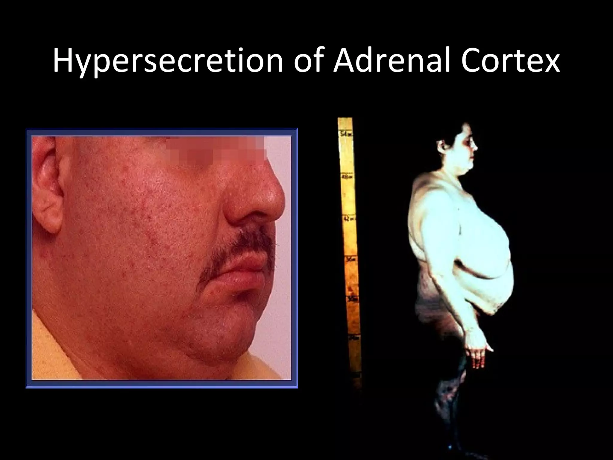 Hypersecretion of Adrenal Cortex
 