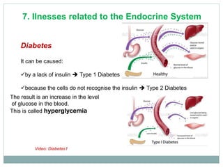 Diabetes
It can be caused:
by a lack of insulin  Type 1 Diabetes
because the cells do not recognise the insulin  Type 2 Diabetes
The result is an increase in the level
of glucose in the blood.
This is called hyperglycemia
7. Ilnesses related to the Endocrine System
Video: Diabetes1
 