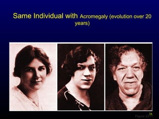 28
Figure 23-17
Same Individual with Acromegaly (evolution over 20
years)
 