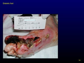 99
Diabetic foot
 