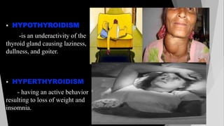  HYPOTHYROIDISM 
-is an underactivity of the 
thyroid gland causing laziness, 
dullness, and goiter. 
 HYPERTHYROIDISM 
- having an active behavior 
resulting to loss of weight and 
insomnia. 
 