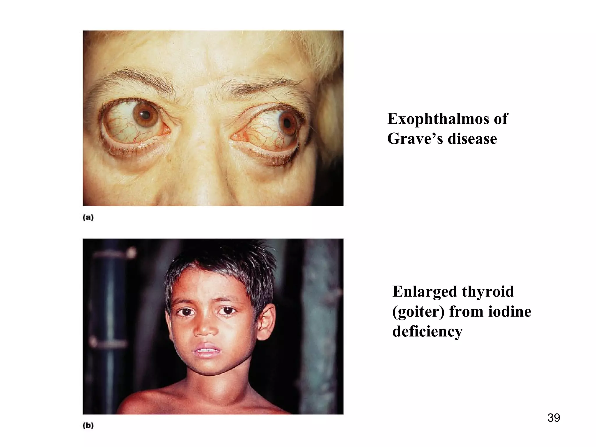 39
Exophthalmos of
Grave’s disease
Enlarged thyroid
(goiter) from iodine
deficiency
 
