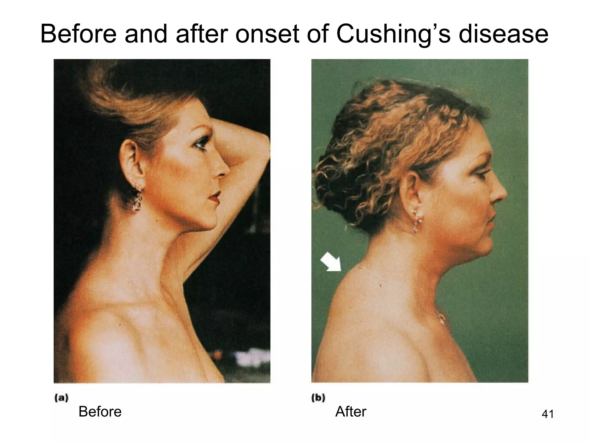 41
Before and after onset of Cushing’s disease
AfterBefore
 