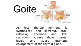 Goiter
As less thyroid hormone is
synthesized and secreted, TSH-
releasing hormone and TSH
secretion increase above normal
levels and cause dramatic
enlargement of the thyroid gland.
 