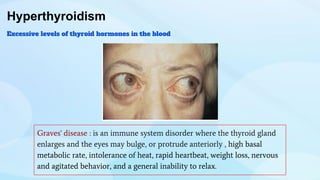 Hyperthyroidism
Excessive levels of thyroid hormones in the blood
Graves' disease : is an immune system disorder where the thyroid gland
enlarges and the eyes may bulge, or protrude anteriorly , high basal
metabolic rate, intolerance of heat, rapid heartbeat, weight loss, nervous
and agitated behavior, and a general inability to relax.
 