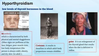 Hyporthyroidism
low levels of thyroid hormones in the blood
goiter :It is an enlargement of
the thyroid gland that results
when the diet is deficient in
iodine.
Cretinism : it results in
dwarfism in which adult body
proportions remain childlike.
Myxedema
which is characterized by both
physical and mental sluggishness
,Other signs are puffiness of the
face, fatigue, poor muscle tone,
low body temperature (the
person is always cold), obesity,
and dry skin. (in adult ).
 