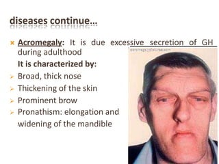 diseases continue…
 Acromegaly: It is due excessive secretion of GH
during adulthood
It is characterized by:
 Broad, thick nose
 Thickening of the skin
 Prominent brow
 Pronathism: elongation and
widening of the mandible
 