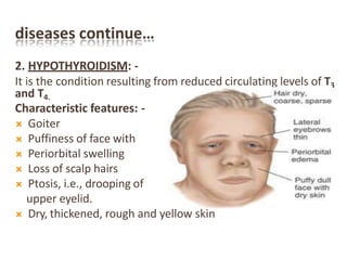 diseases continue…
2. HYPOTHYROIDISM: -
It is the condition resulting from reduced circulating levels of T3
and T4.
Characteristic features: -
 Goiter
 Puffiness of face with
 Periorbital swelling
 Loss of scalp hairs
 Ptosis, i.e., drooping of
upper eyelid.
 Dry, thickened, rough and yellow skin
 