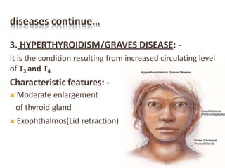 diseases continue…
3. HYPERTHYROIDISM/GRAVES DISEASE: -
It is the condition resulting from increased circulating level
of T3 and T4
Characteristic features: -
 Moderate enlargement
of thyroid gland
 Exophthalmos(Lid retraction)
 