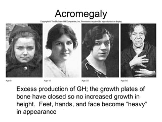 Acromegaly
Excess production of GH; the growth plates of
bone have closed so no increased growth in
height. Feet, hands, and face become “heavy”
in appearance
 