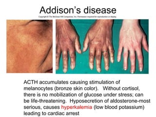 Addison’s disease
ACTH accumulates causing stimulation of
melanocytes (bronze skin color). Without cortisol,
there is no mobilization of glucose under stress; can
be life-threatening. Hyposecretion of aldosterone-most
serious, causes hyperkalemia (low blood potassium)
leading to cardiac arrest
 