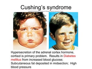 Cushing’s syndrome
Hypersecretion of the adrenal cortex hormone,
cortisol is primary problem. Results in Diabetes
mellitus from increased blood glucose;
Subcutaneous fat deposited in midsection; High
blood pressure
 