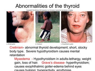 Abnormalities of the thyroid
Cretinism- abnormal thyroid development; short, stocky
body type. Severe hypothyroidism causes mental
retardation
Myxedema - Hypothyroidism in adults-lethargy, weight
gain, loss of hair. Grave’s disease- hyperthyroidism;
causes exophthalmic goiter-edema behind eyes
 